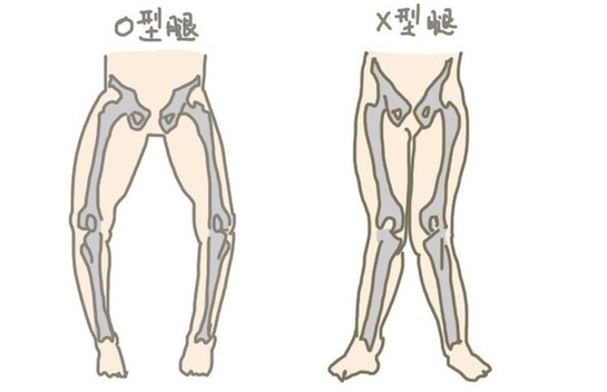O型腿的原因是什么？如何矫正O型腿