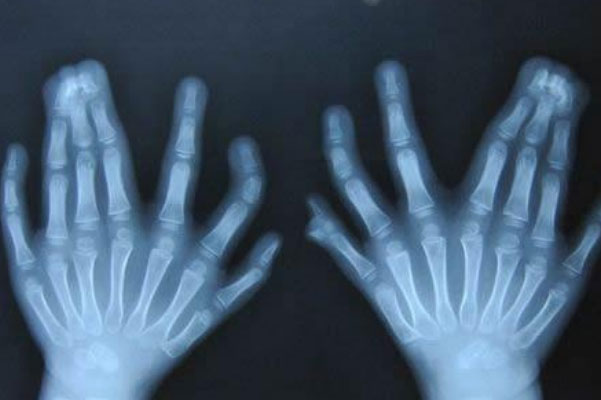 世界上手指脚趾最多的人：印度男孩有34个手指和脚趾