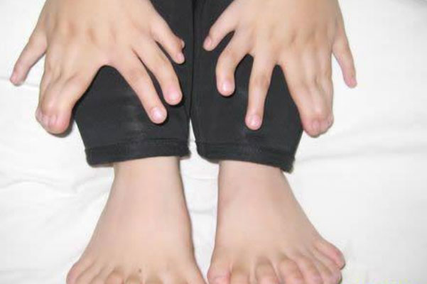 世界上手指脚趾最多的人：印度男孩有34个手指和脚趾