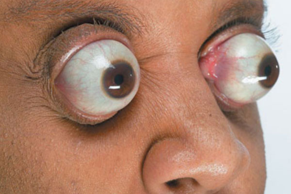 世界上最长的眼球：突出眼眶高达11毫米