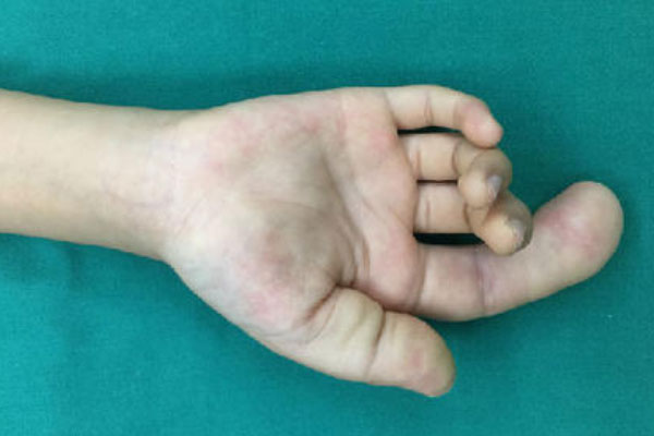 世界上最大的手指，食指长度高达30厘米