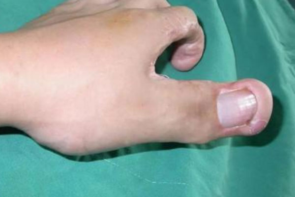 世界上最大的手指，食指长度高达30厘米
