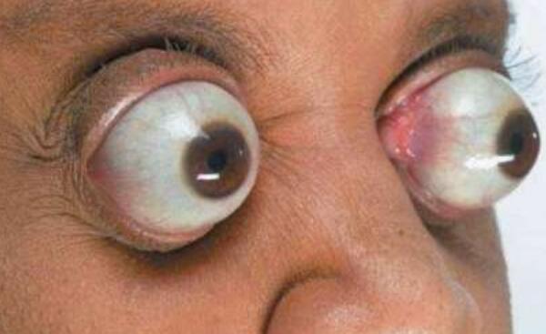 世界上眼球最突出的人，约翰·道尔的眼睛能凸出12毫米